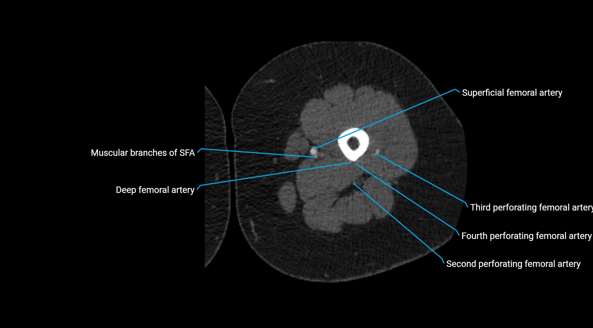 CTA lower limb cross sectional anatomy labelled image _126.webp
